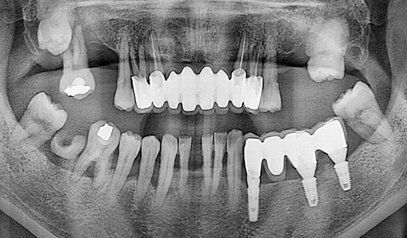 X-RAY 치료 전