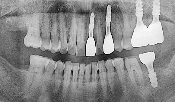X-RAY 치료 후