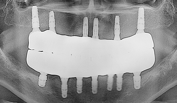 X-RAY 치료 후