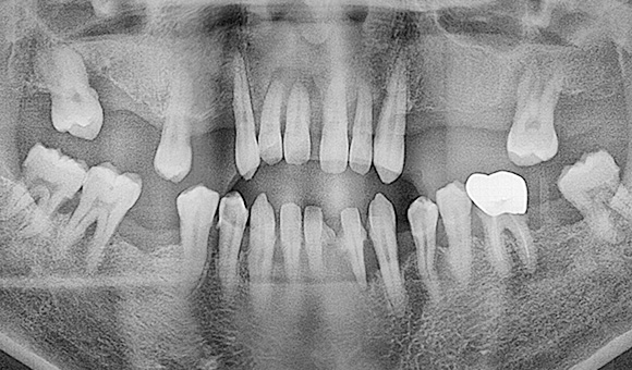 X-RAY 치료 전