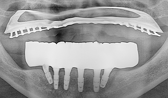 X-RAY 치료 후
