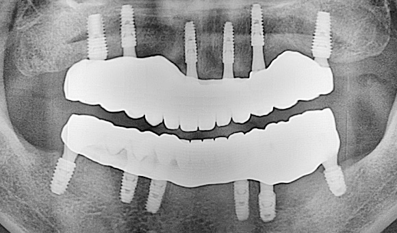 X-RAY 치료 후