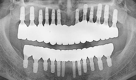 X-RAY 치료 후
