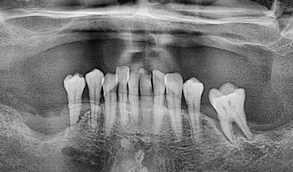 X-RAY 치료 전