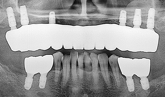 X-RAY 치료 후