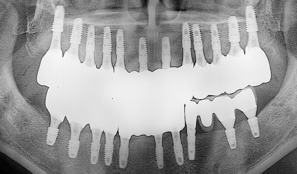 X-RAY 치료 후