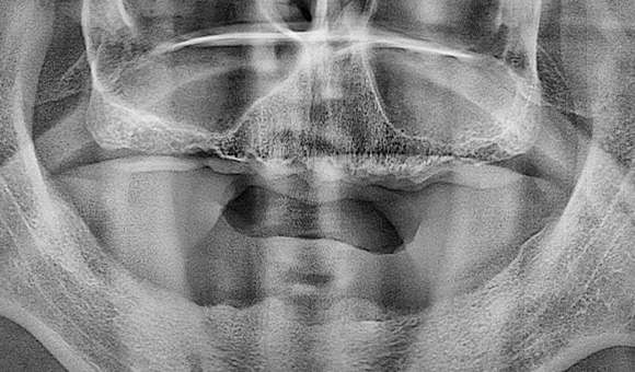 X-RAY 치료 전