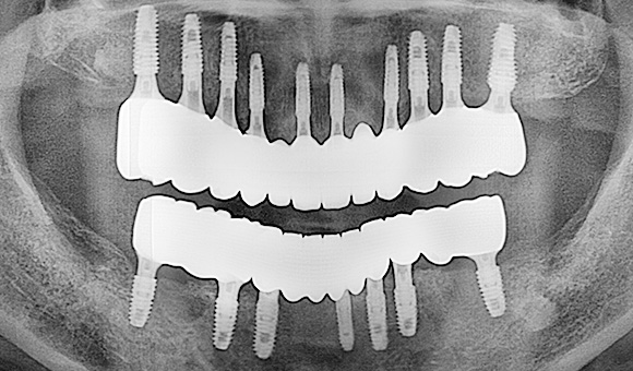 X-RAY 치료 후