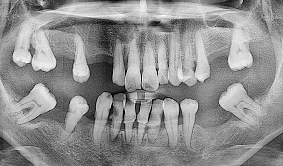 X-RAY 치료 전