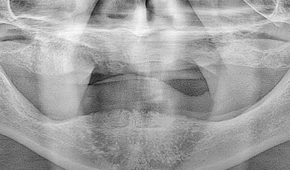X-RAY 치료 전