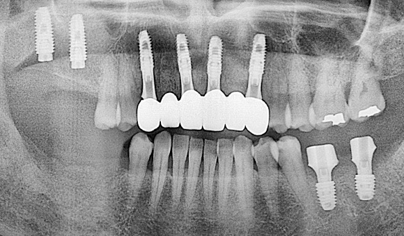 X-RAY 치료 후