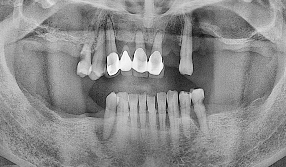 X-RAY 치료 전